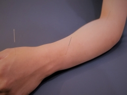 Treating the Arm with Acunpuncture
